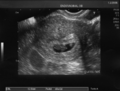 http://upload.wikimedia.org/wikipedia/commons/thumb/1/18/Scan07semanas.png/120px-Scan07semanas.png
