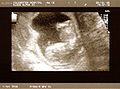 http://upload.wikimedia.org/wikipedia/commons/thumb/c/c0/Scan12weeks.jpg/120px-Scan12weeks.jpg