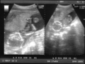 http://upload.wikimedia.org/wikipedia/commons/thumb/9/96/Scan17semanas1.png/120px-Scan17semanas1.png